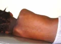 DR