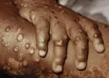 DR